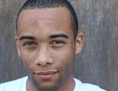 male with acne and hyperpigmentation