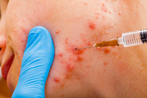 cystic acne injection