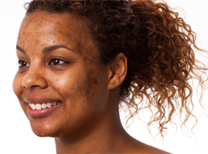 skin hyperpigmentation acne