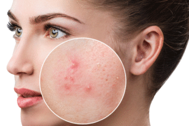 acne and pimples on face