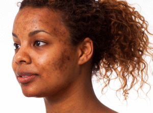 acne hyperpigmentation on face