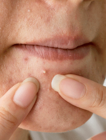 adult acne on chin