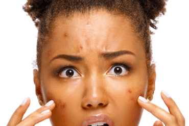 acne caused by hair