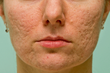 woman with severe acne scars