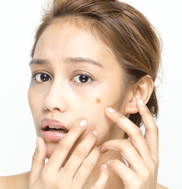 acne skin breakout