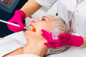 strong chemical peel percentage