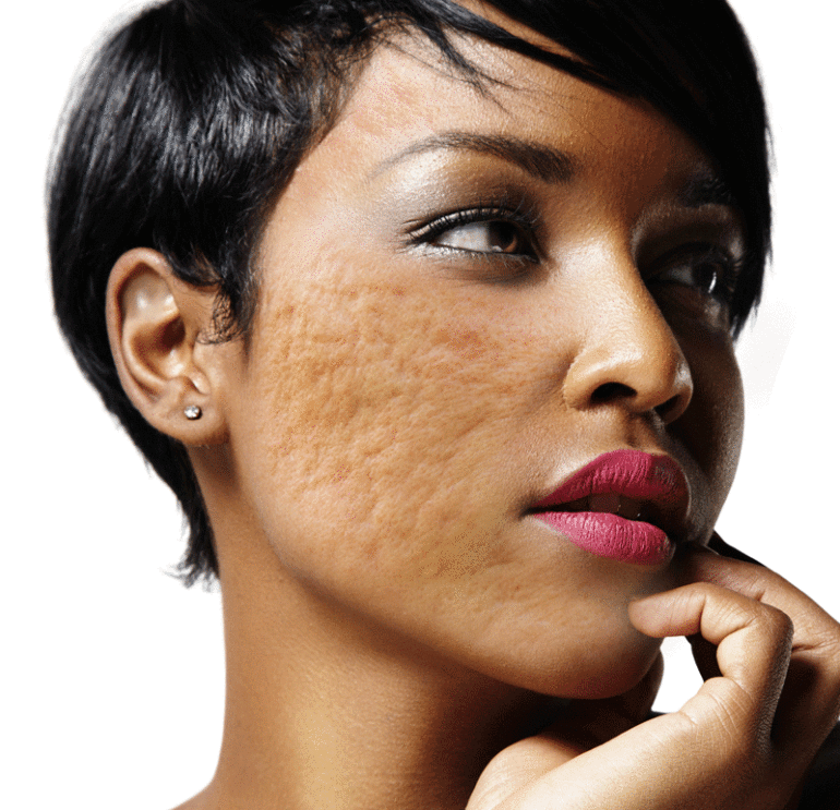 Causes, Types & Prevention of Acne Scars Aesthetic Skin & Antiaging