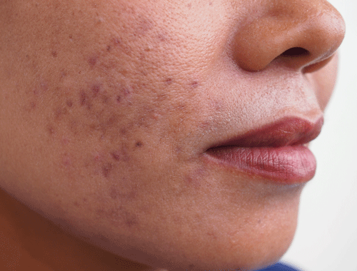 microneedling for pigmentation