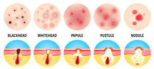 types and grades of acne