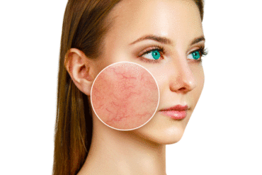 close up skin with rosacea