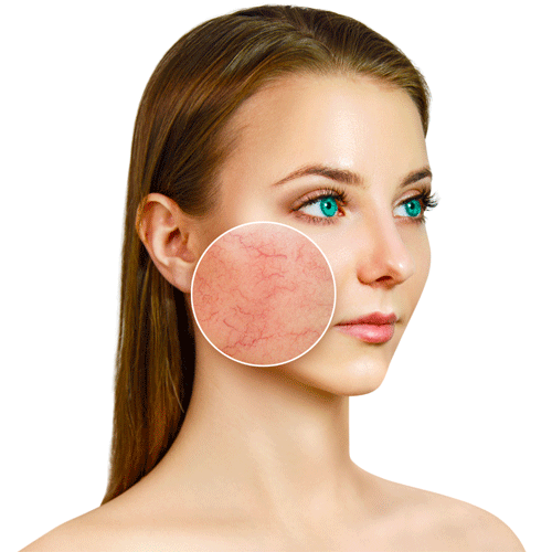 close up skin with rosacea